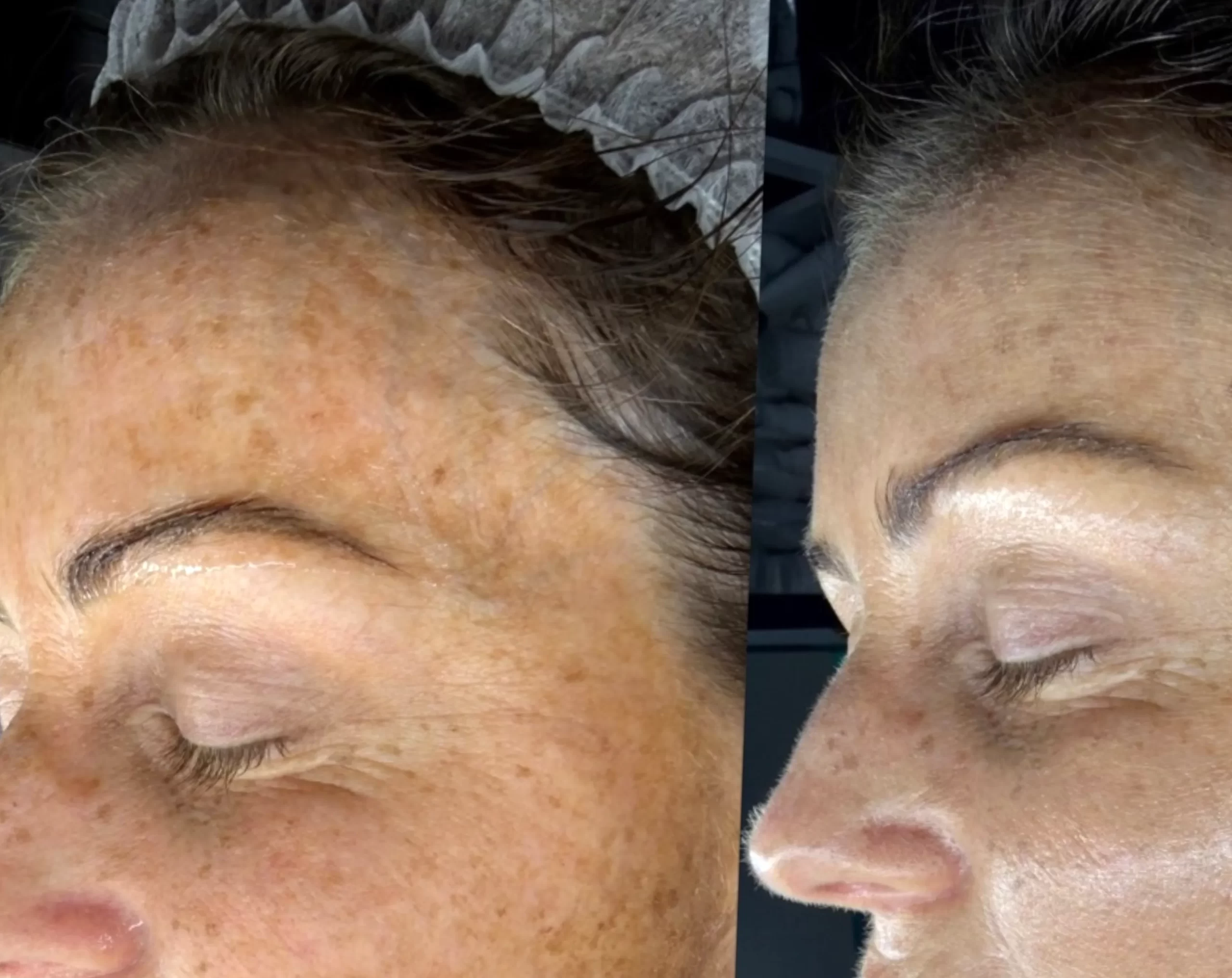 niacinamide for skin barrier