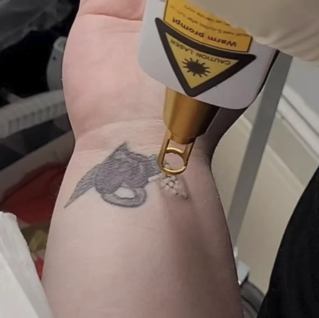 tattoo removal course sydney